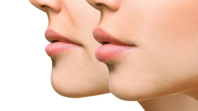FOR LIPS FILLER INJECTIONS – 10% OFF